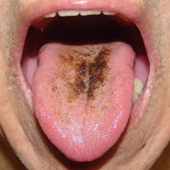 tongue-scraper-for-tongue.jpeg